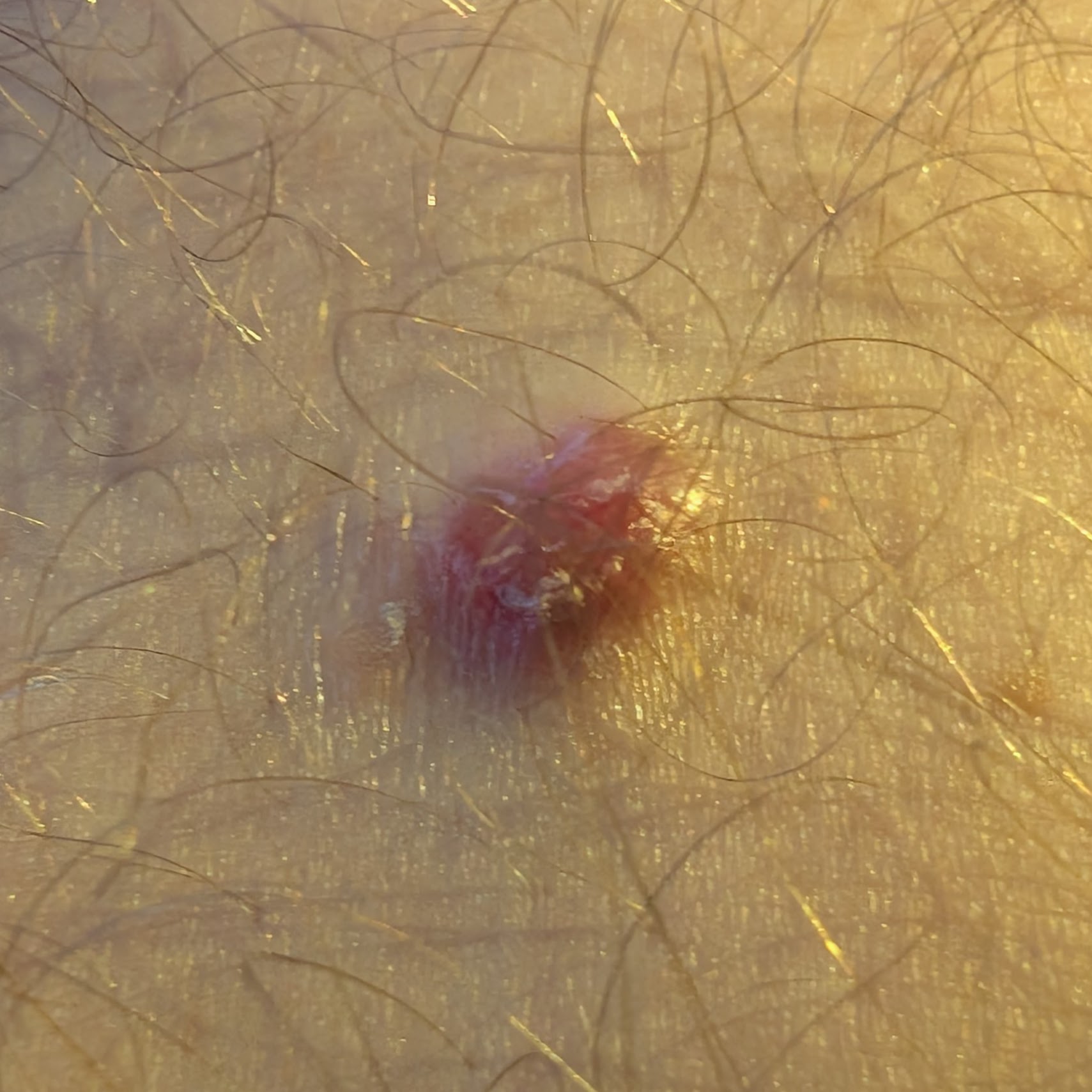 Suspicious mole, before biopsy
