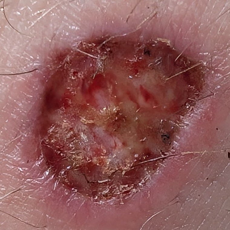 Biopsy site, post-procedure