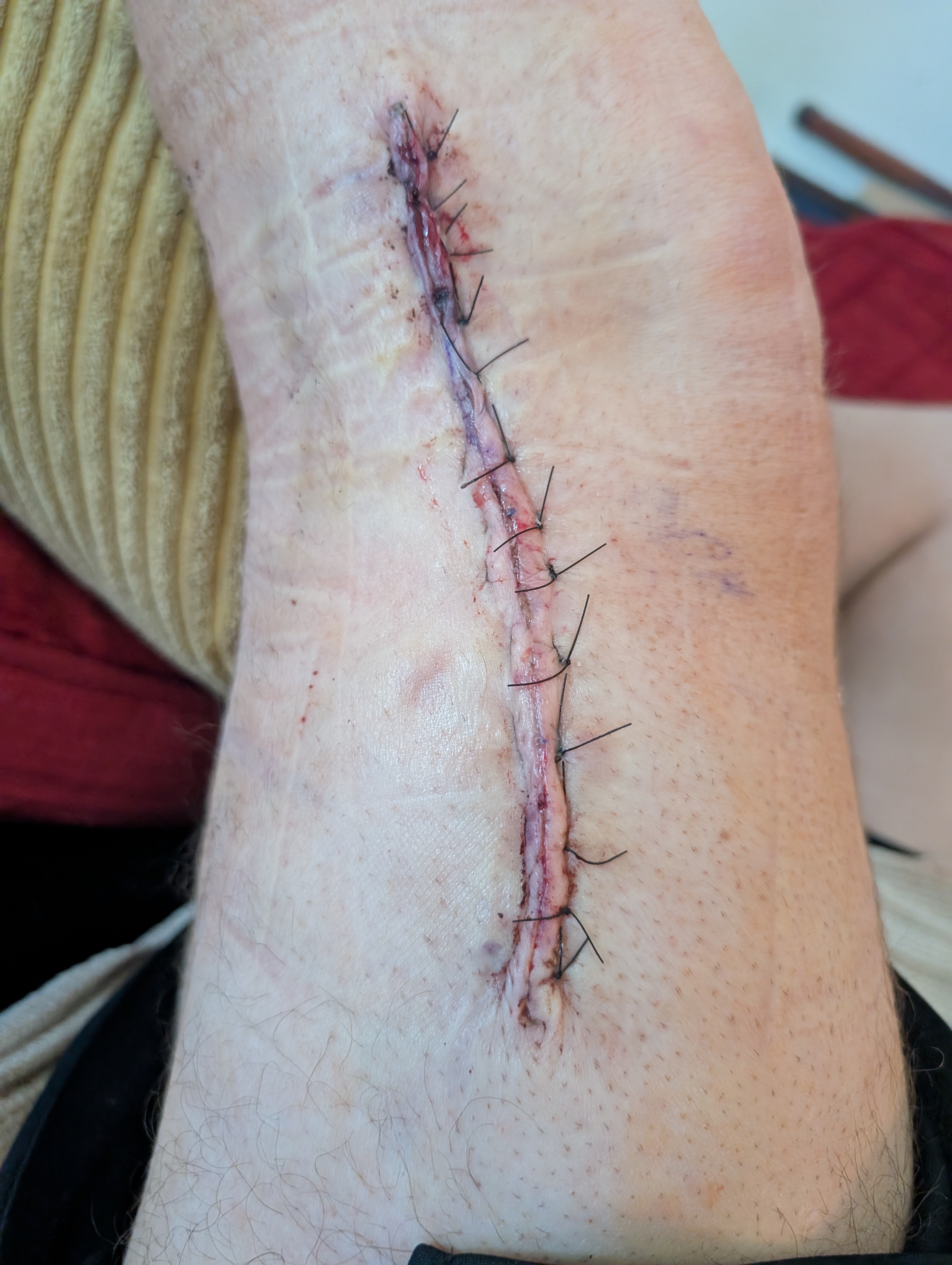 Surgical incision with sutures, close-up
