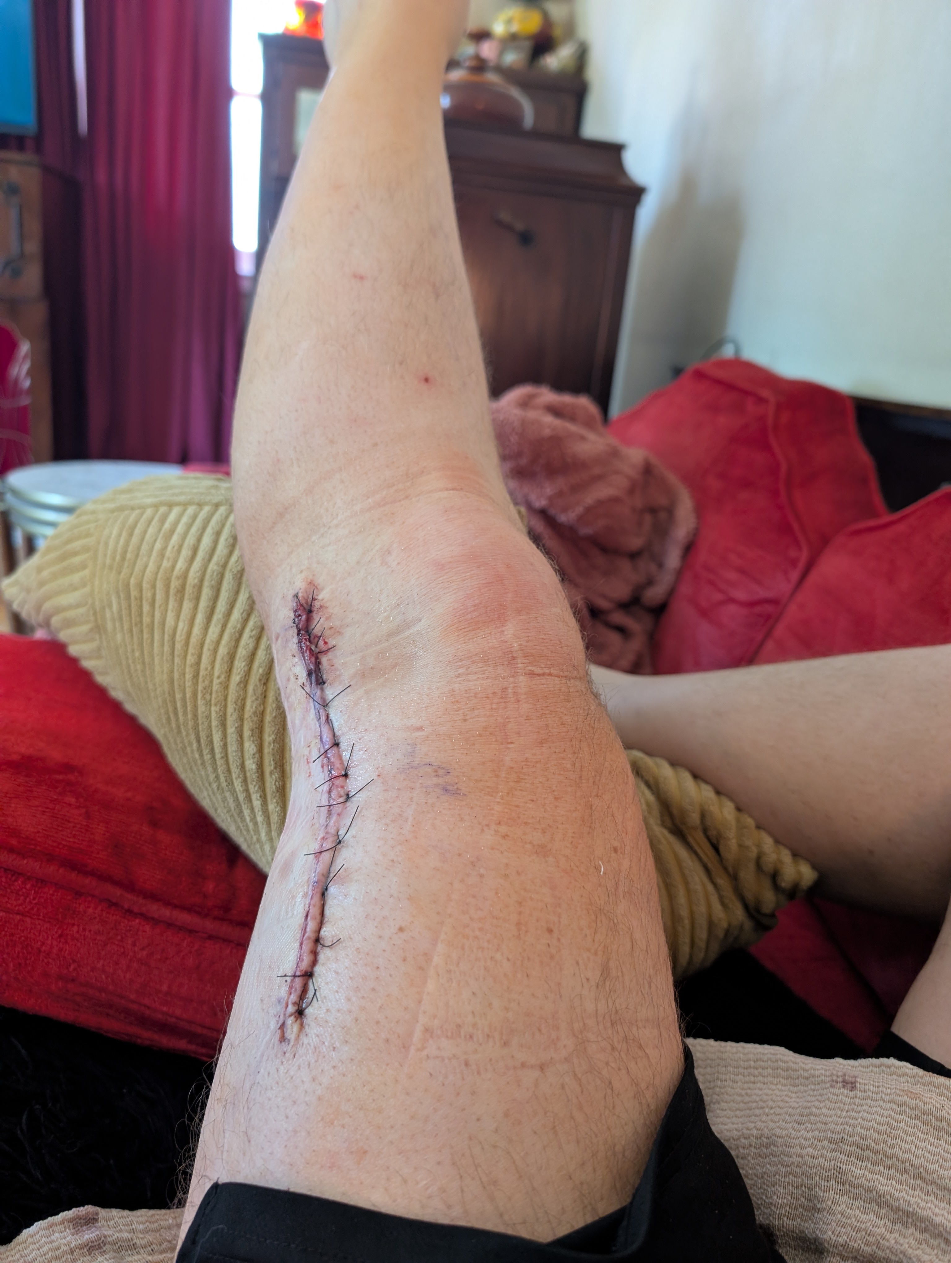 Surgical incision with sutures, full view