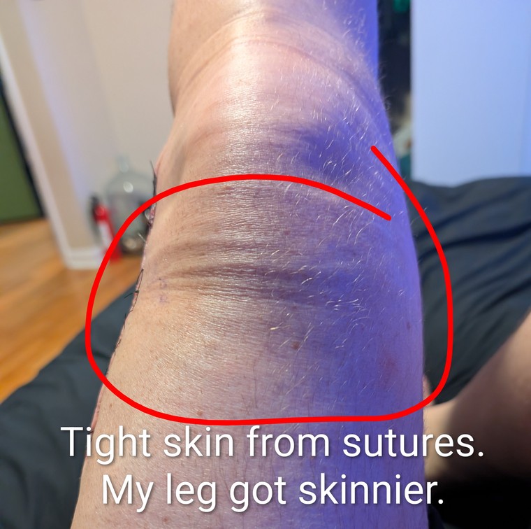 Arm incision site, skin tight from sutures