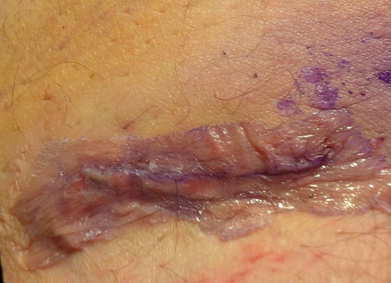 Groin lymph node surgery site, close-up