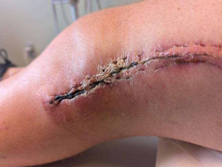 Incision site after sutures removed early due to infection