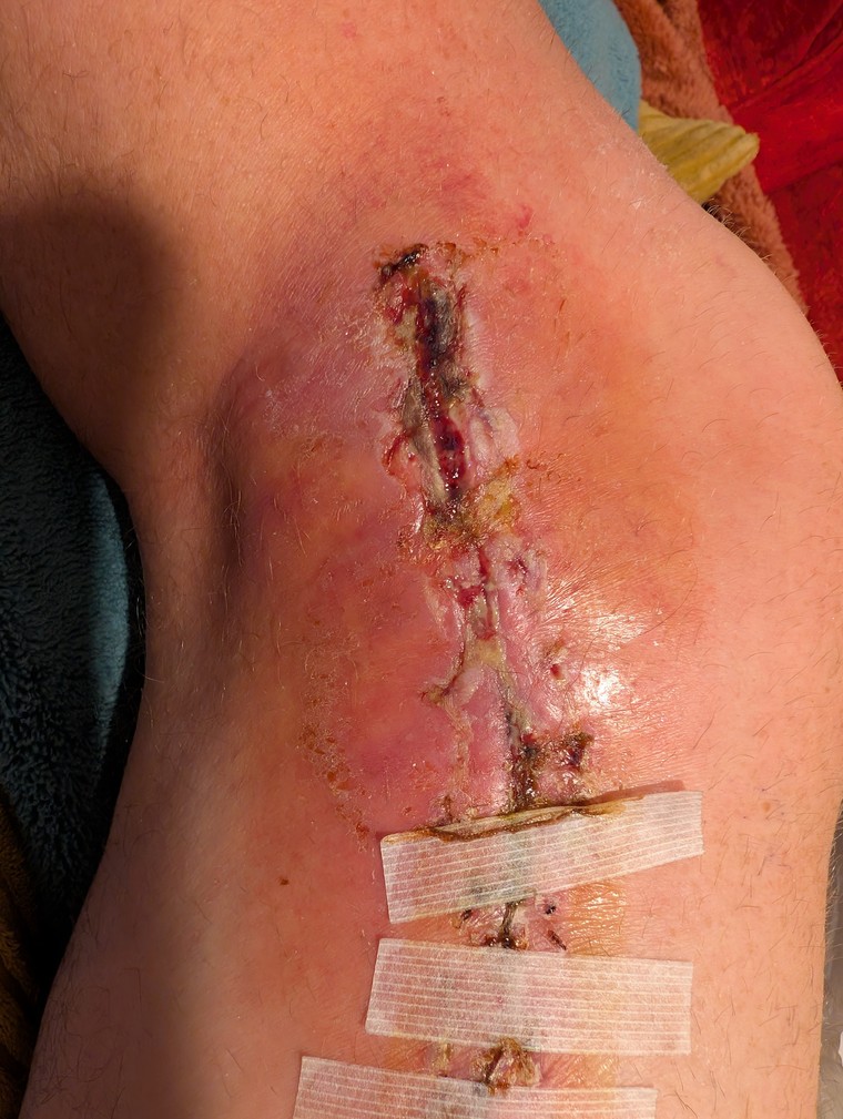 Infection at incision site, day 2
